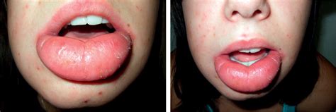 What Causes Sudden Swelling Of The Lower Lip Sitelip Org