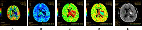 Maps Of Ct And Ctp In An Ich Patient Example A Cerebral Blood Flow