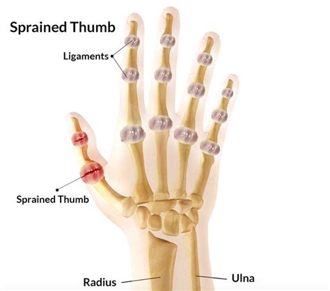 Thumb Injury Orthopedics Sports Injury Sprain