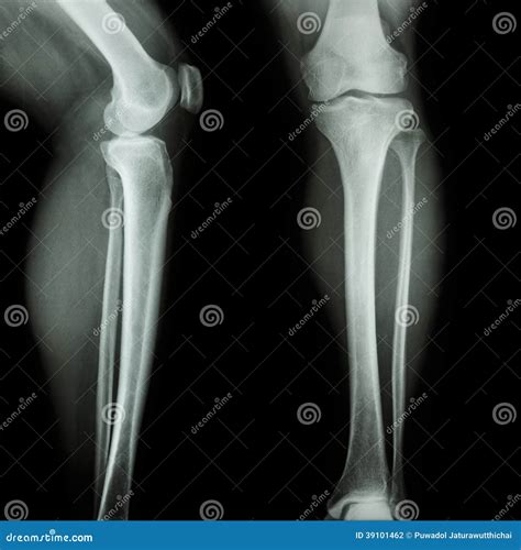 X Ray Film Of A Knee Of A Patient With Fractured Proximal Fibula