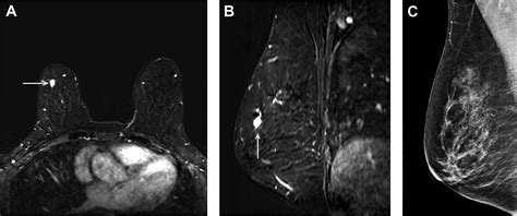 Magnetic Resonance Imaging In Screening Of Breast Cancer Radiology Key