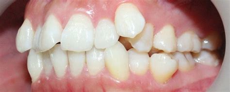 Why Are Teeth Misaligned Vinmec