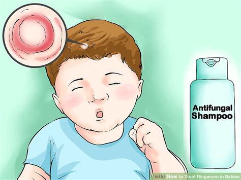 3 Ways To Treat Ringworm In Babies Wikihow