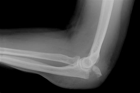 Causes Of Elbow Pain Austin Tx Orthopaedic Specialists Of Austin