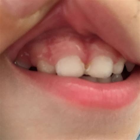 Das zahnen ist harte arbeit für ein baby und sein körper ist geschwächt und damit anfälliger für einen infekt. Was hat mein Sohn am Zahn? (Kinder, Zähne)