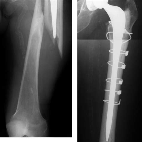 A Vancouver B2 Periprosthetic Fracture Revised Using The Download