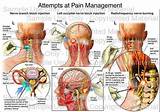 Images of Chiari Pain Management