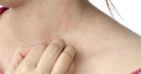 What Causes Hives Hives Causes In Children And Adults