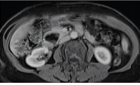 Figure 5 From A Duodenal Diverticula Causing A Lemmel Syndrome A Case