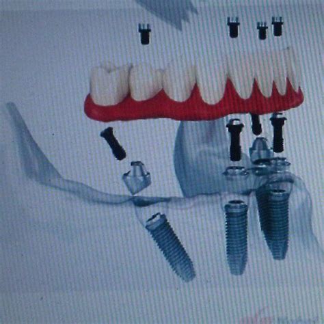All On 4 Dental Implants And Services Chicago Il
