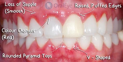 How To Recognize Gum Disease What Do Normal Healthy Gums Look Like