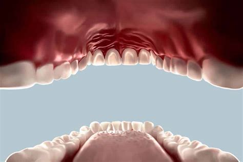 Roof Of Mouth Hurts 8 Possible Causes To Be Taken Seriously