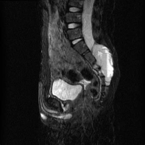 Aneurysmal Bone Cyst Sacrum Image