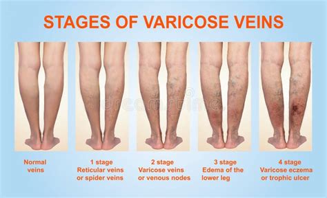 Varicose Veins On A Female Senior Leg Stock Photo Image Of Problem