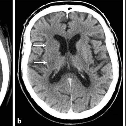 A Ct Angiography Of The Brain Showed An Occlusion In The Distal Part Of Download Scientific