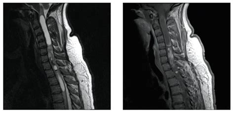 Helping Patients Facing Surgery For Intramedullary Cervical Spine