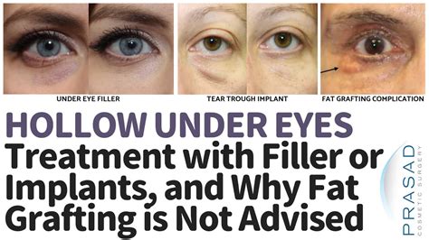 What Is The Best Treatment For Under Eye Hollows Dr Prasad Blog