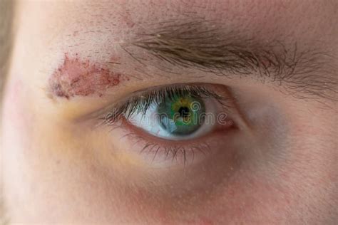 Suture Wound On Face Of Young Man Close Up Stock Photo Image Of