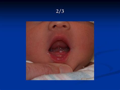 Ppt Common Newborn Findings Powerpoint Presentation Free Download