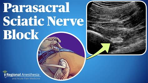 Ultrasound Guided Parasacral Sciatic Nerve Block Youtube