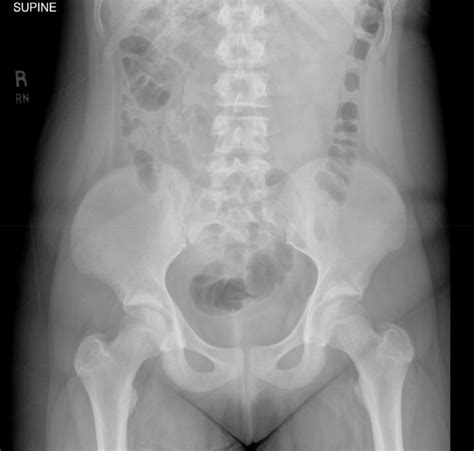 Moderate Stool Burden With Non Obstructive Bowel Gas Pattern