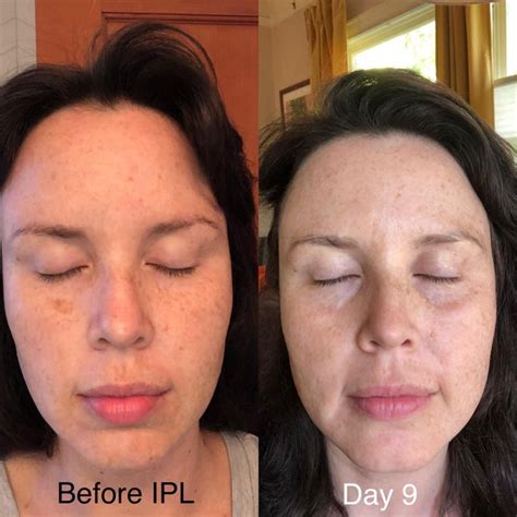 38yo Ipl Photofacial Results One Treatment R30plusskincare