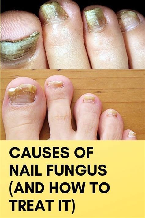 20 Fingernail Fungus From Acrylic Nails Nails Art Design Compilations