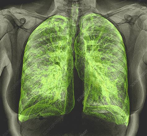 Healthy Lungs Ct Scan Stock Image C0488761 Science Photo Library