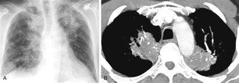 Diffuse Lung Disease With Calcification And Lipid Radiology Key