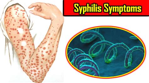 You are more at risk of hiv infection during sexual contact if you have syphilis symptoms. Syphilis Symptoms: Youn Sancharit Bimari ke Lakshan