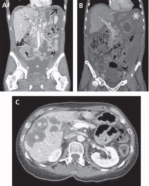 Differential Radiographic Appearance Of Braf V600emutant Metastatic Colorectal Cancer In