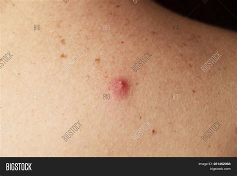 Photo Pimple Pus On Image And Photo Free Trial Bigstock