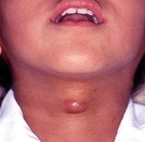 Neck Masses In Children Pediatric Emergency Playbook