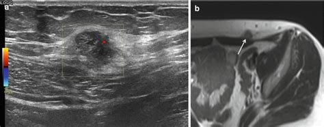 Ultrasound And Color Doppler Ultrasound Of Soft Tissue Tumors And