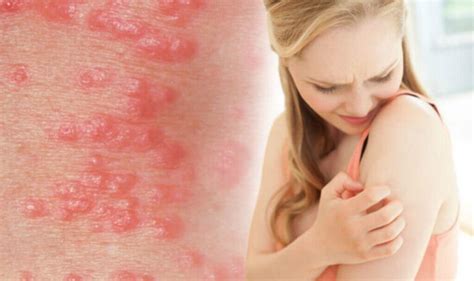 Scabies Signs And Symptoms Complication Treatment Prevention