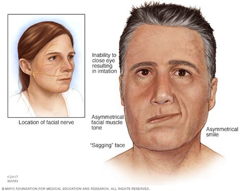 Bells Palsy Bell Palsy As An Atypical Presenting Symptom Of Type 2