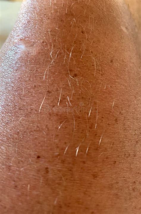 Hairy Leg Stock Photo Image Of Pigment Hairy Skin