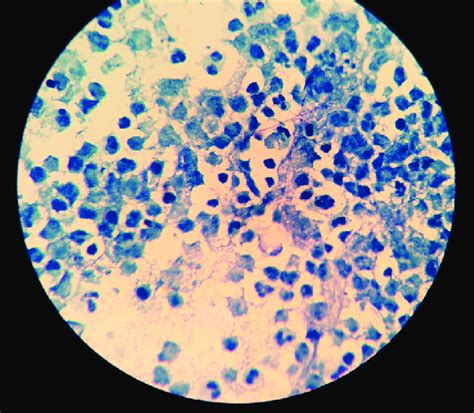 Modified Ziehl Neelsen Staining Of Brain Abscess Using Sulfuric Acid