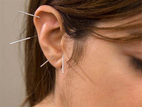Acupuncture For Tinnitus Exploring An Ancient Practice For Modern Relief