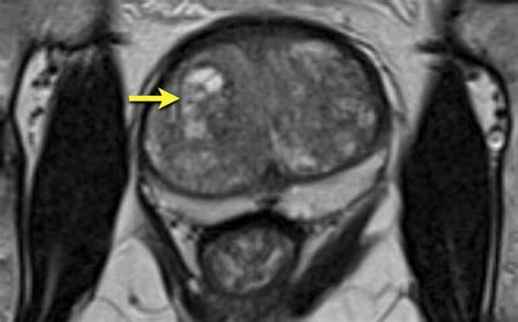 The Radiology Assistant Prostate Cancer PI RADS V