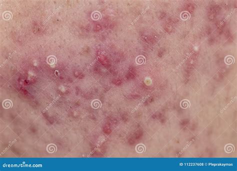Dermatological Disease Acne Stock Photo Image Of Unhealthy Blemishes