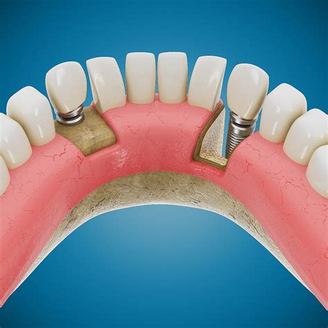 3d Dental Implant