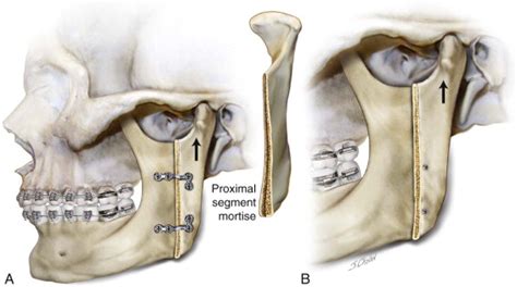 Intraoral Vertical Ramus Osteotomy Pocket Dentistry