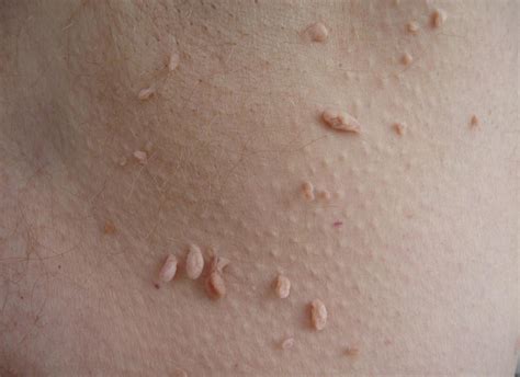 7 Types Of Skin Moles And Exactly What To Do About Them Healthista