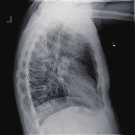 B Chest X Ray Latero Lateral View Oval Lesions In Area Th4th5
