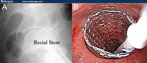 Palliation Of A Malignant Rectal Stricture And Rectovesical Fistula