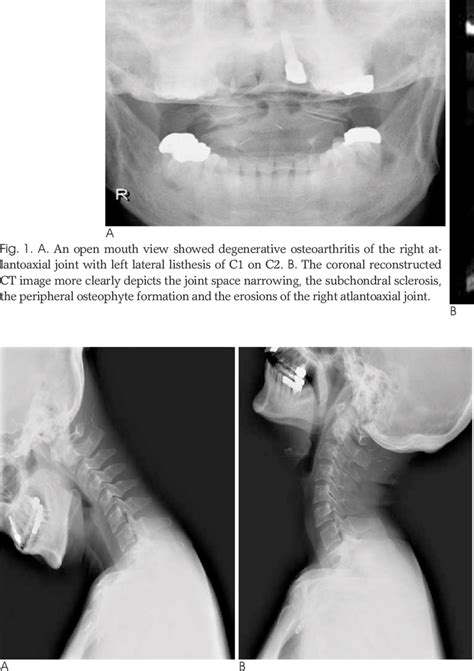 Plain Radiographs Of The Cervical Spine On Flexion A And Extension