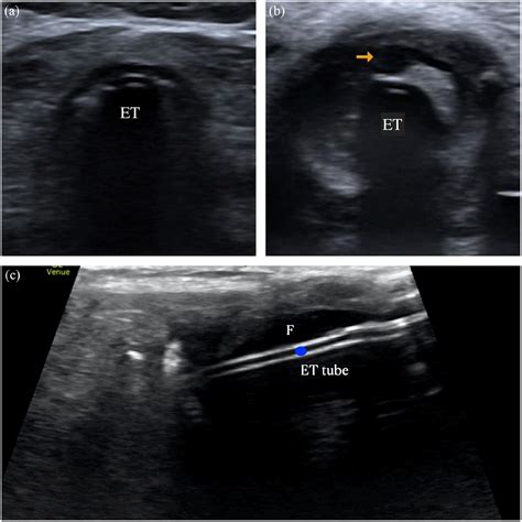 Trans Tracheal Ultrasound A Feasible Method For Endotracheal Tube