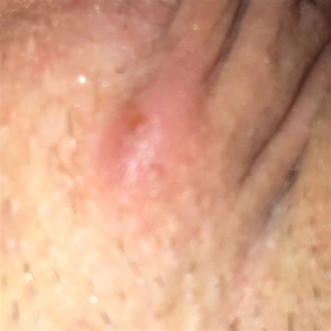 Does Anyone Know What This Could Be It S Like A Bump Right Beside My Clitoris And It Hurts