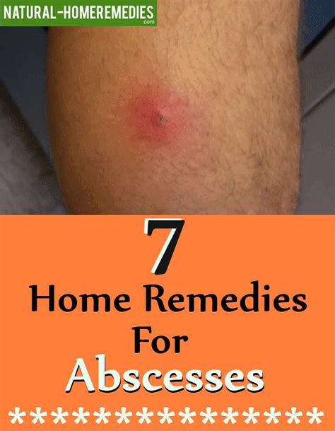 7 Home Remedies For Abscesses Natural Home Remedies And Supplements